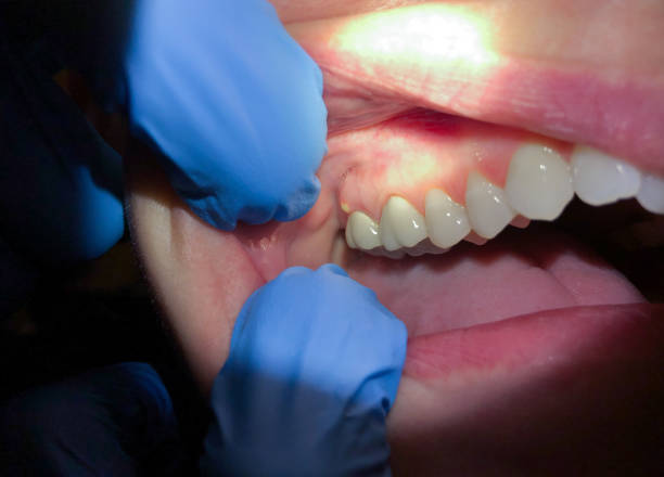 Best Emergency Tooth Extraction in Parsons, TN