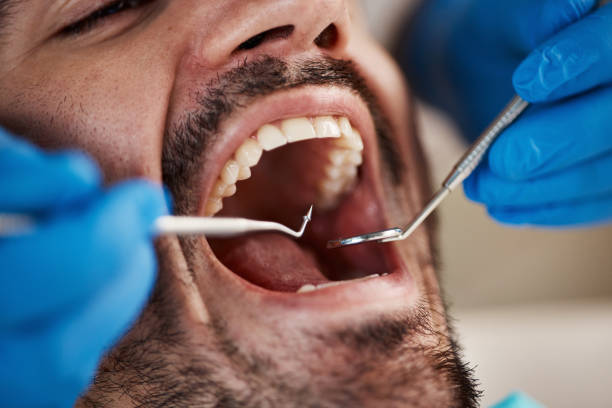 Best Emergency Wisdom Teeth Removal in Parsons, TN