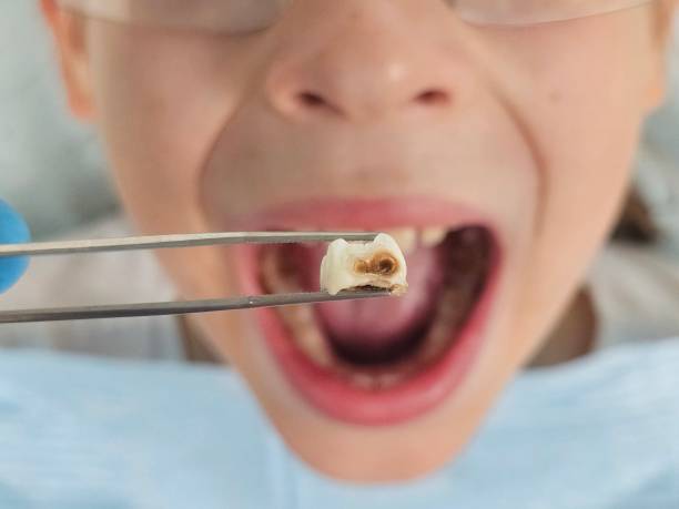Best Emergency Tooth Extraction in Parsons, TN